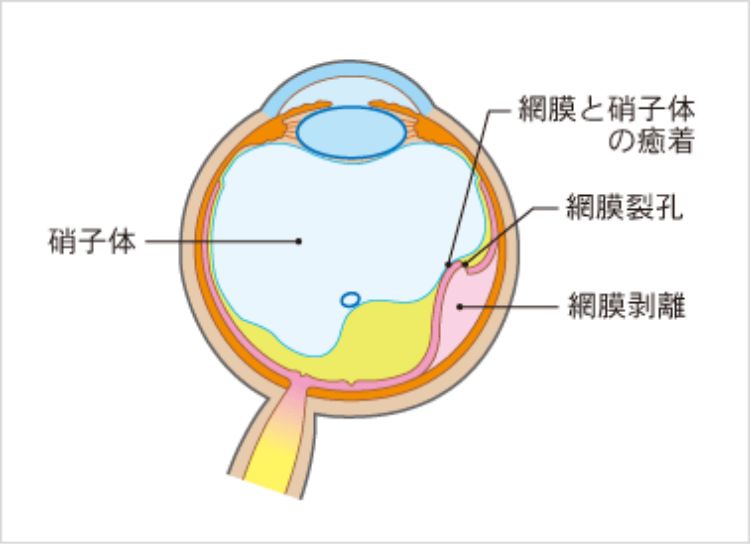 網膜剥離図解