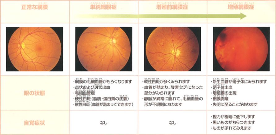 単純網膜症、増殖前網膜症、増殖網膜症の画像と状態・自覚症状解説