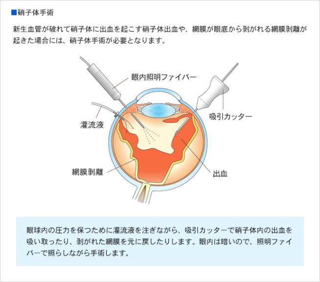 硝子体手術