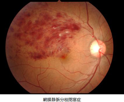 網膜静脈分枝閉塞症の画像