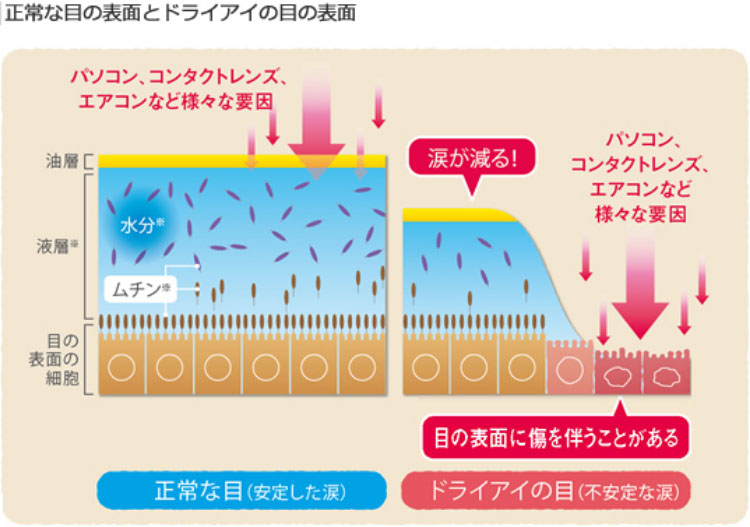 正常な目の表面とドライアイの目の表面の図