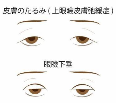 皮膚のたるみ（上眼瞼皮膚弛緩症）・眼瞼下垂