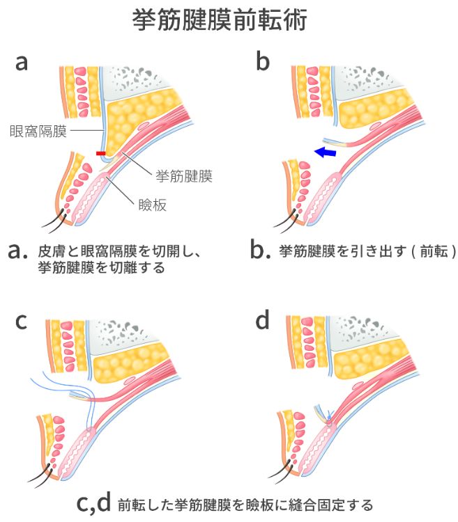 挙筋腱膜前転術図