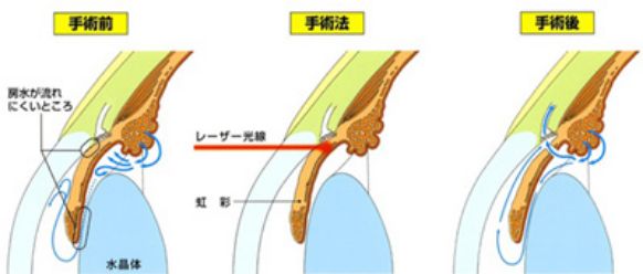 レーザー虹彩切開術の流れのイメージ画像