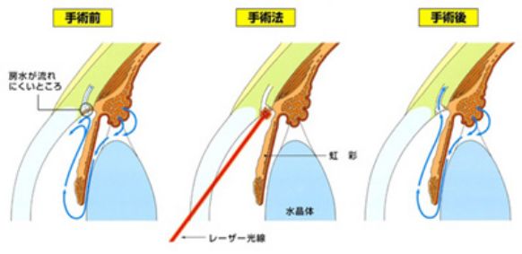 選択的レーザー線維柱帯形成術の流れのイメージ画像