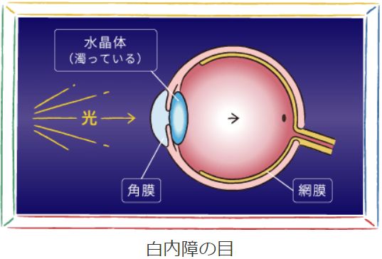 白内障の目 水晶体（濁っている）