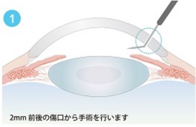 2mm前後の傷口から手術を行います