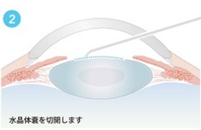 水晶体嚢を切開します