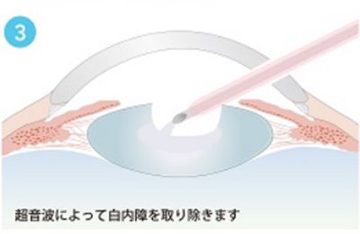 超音波によって白内障を取り除きます