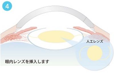 眼内レンズを挿入します