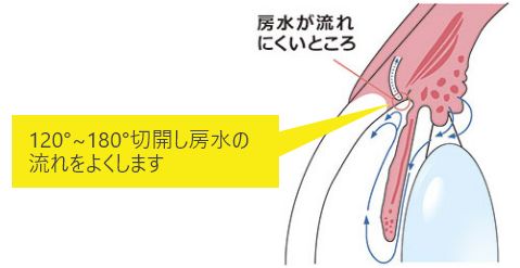 房水が流れにくいところの図 「120°～180°切開し房水の流れをよくします。」