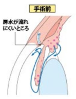 手術前の図