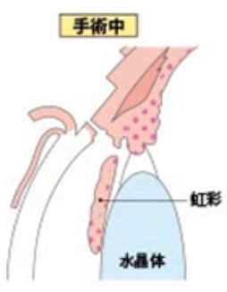 手術中の図