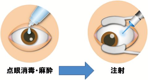 点眼消毒・麻酔→注射