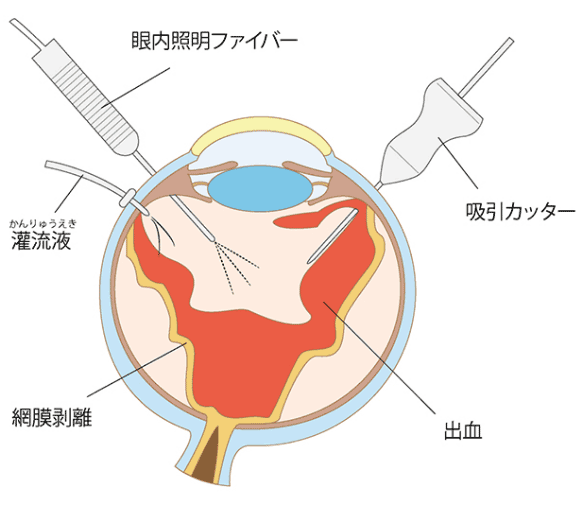 硝子体手術の図